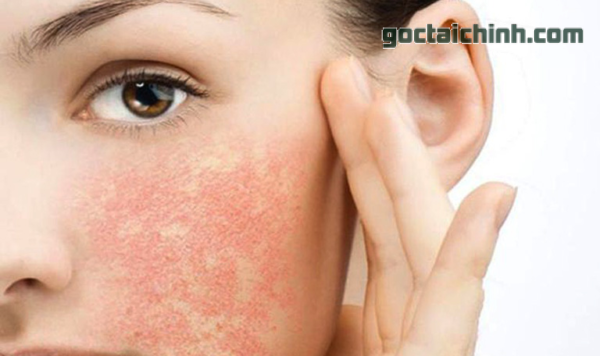 Giảm ngứa, sưng đỏ dị ứng và kích ứng trên da